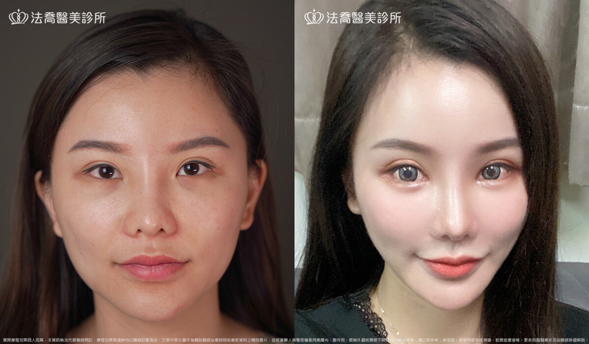 自體肋骨隆鼻