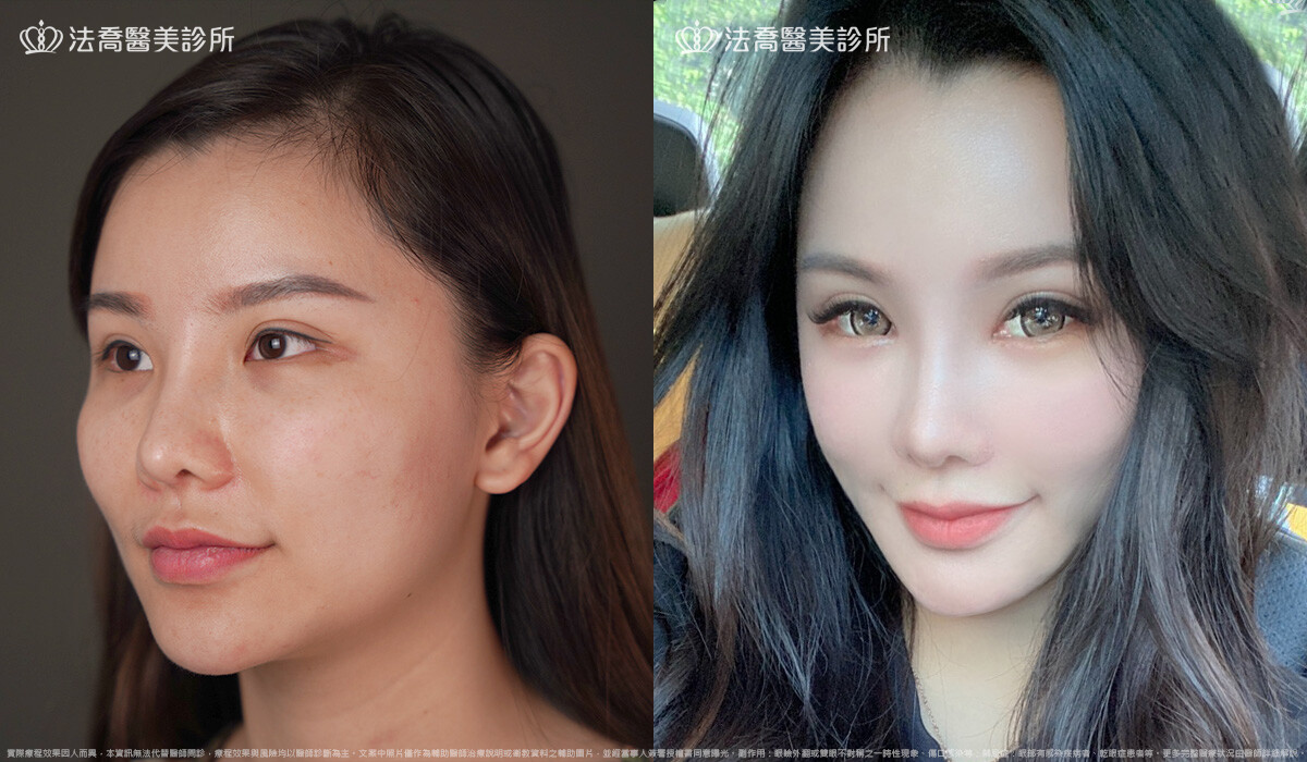 鼻截骨