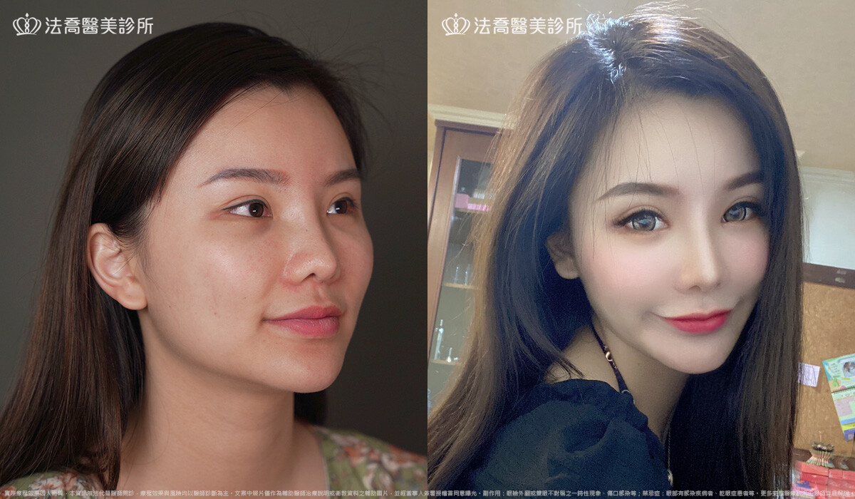 隆鼻推薦