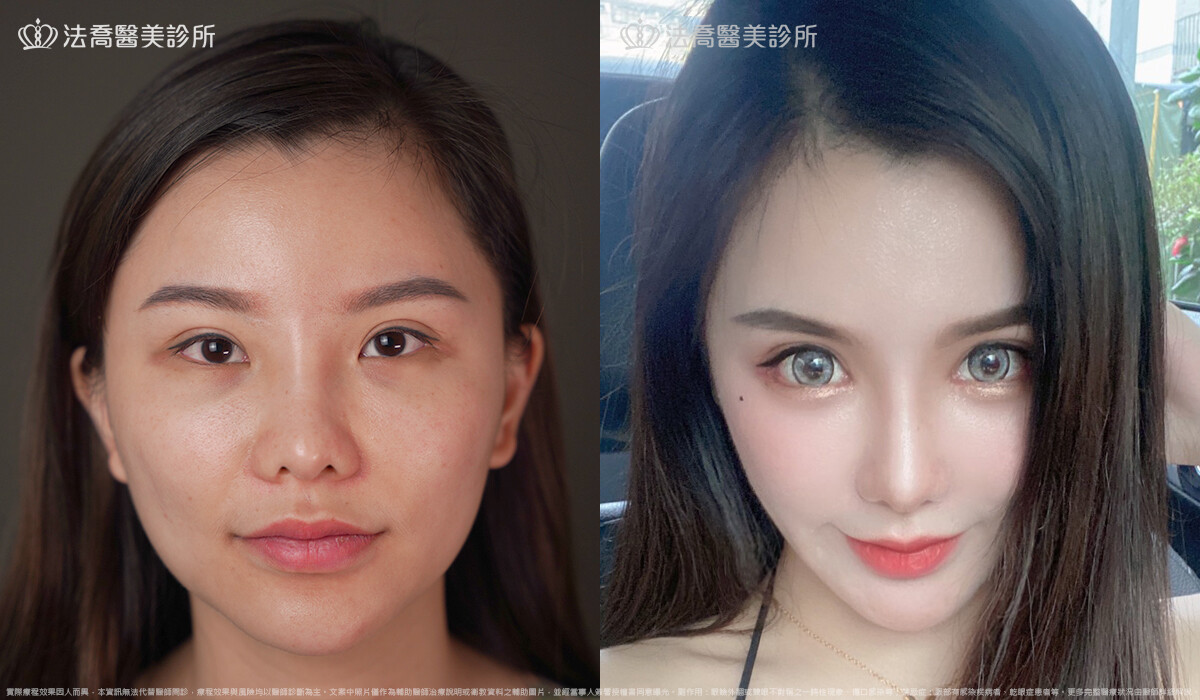自體肋骨隆鼻