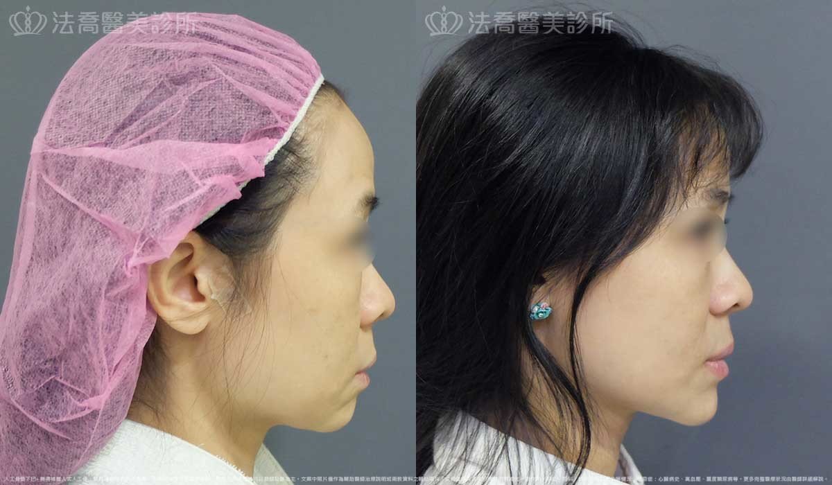 法喬醫美診所,邱浚彥,墊下巴