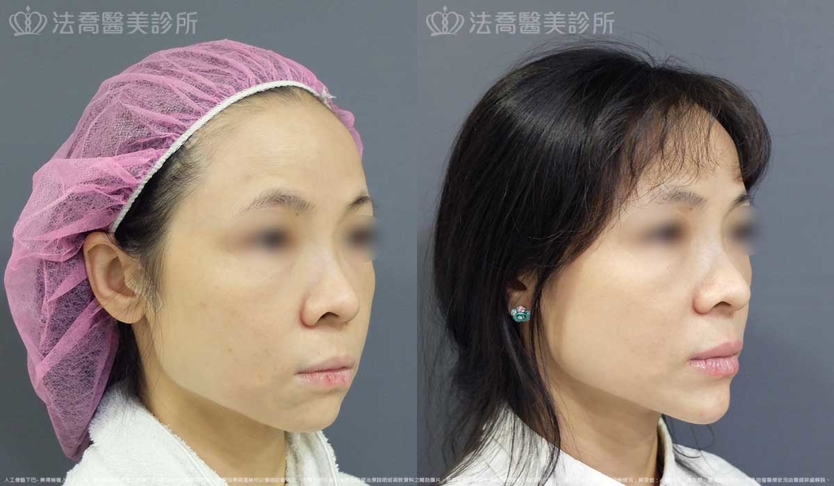 法喬醫美診所,邱浚彥,墊下巴