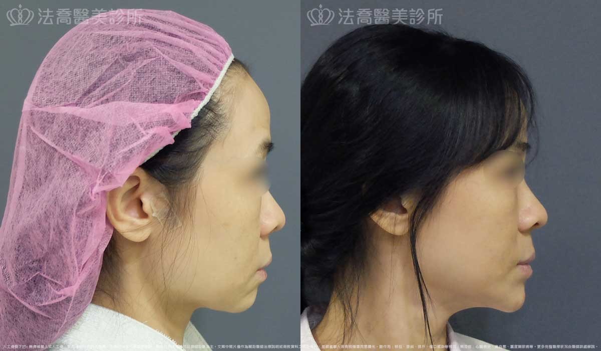 法喬醫美診所,邱浚彥,墊下巴