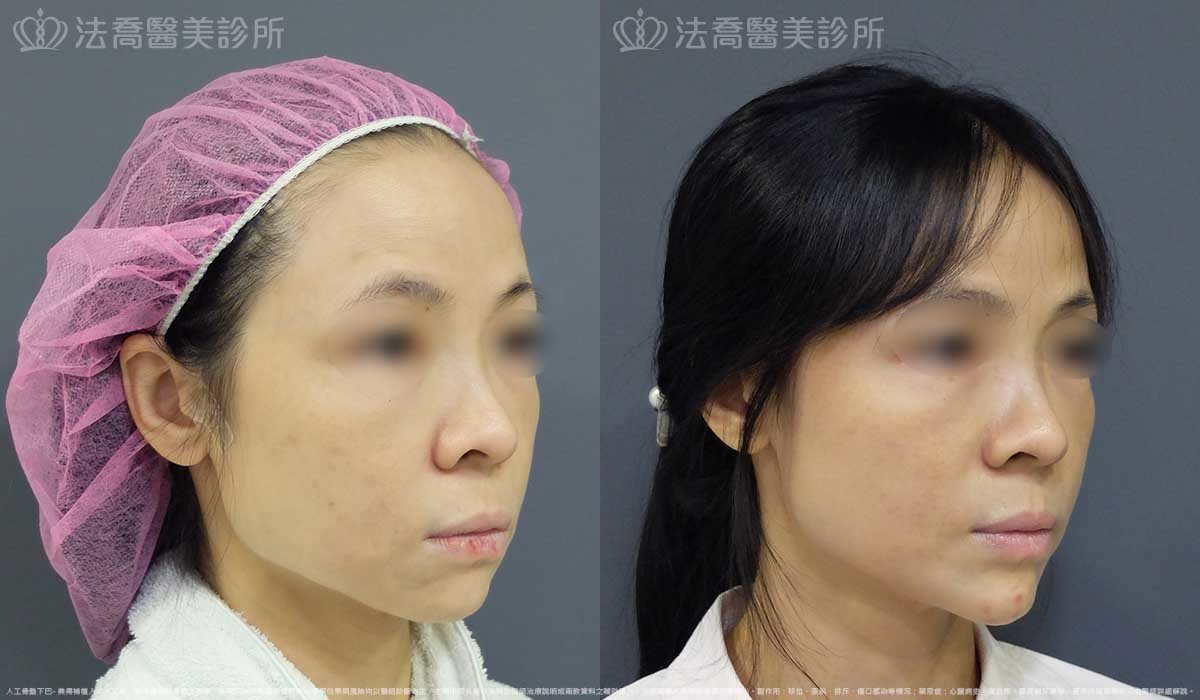 法喬醫美診所,邱浚彥,墊下巴