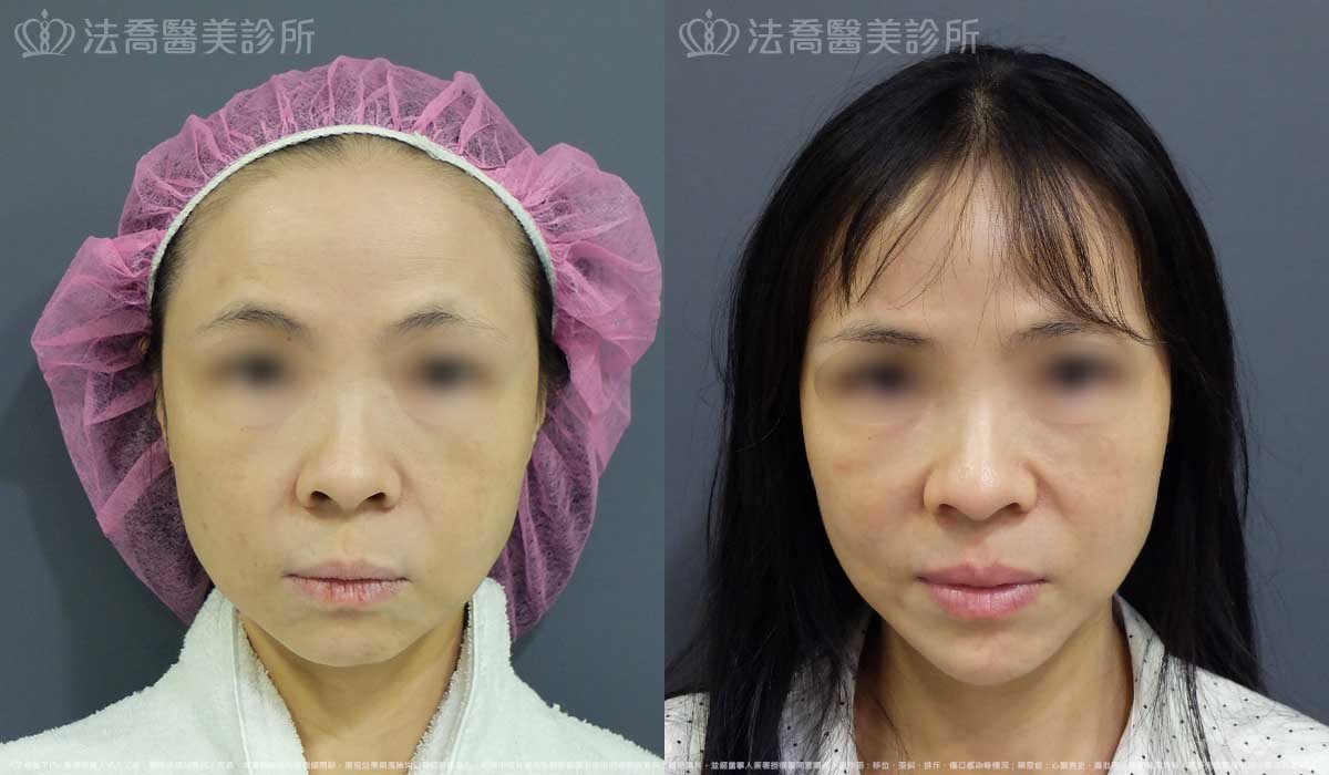 法喬醫美診所,邱浚彥,墊下巴
