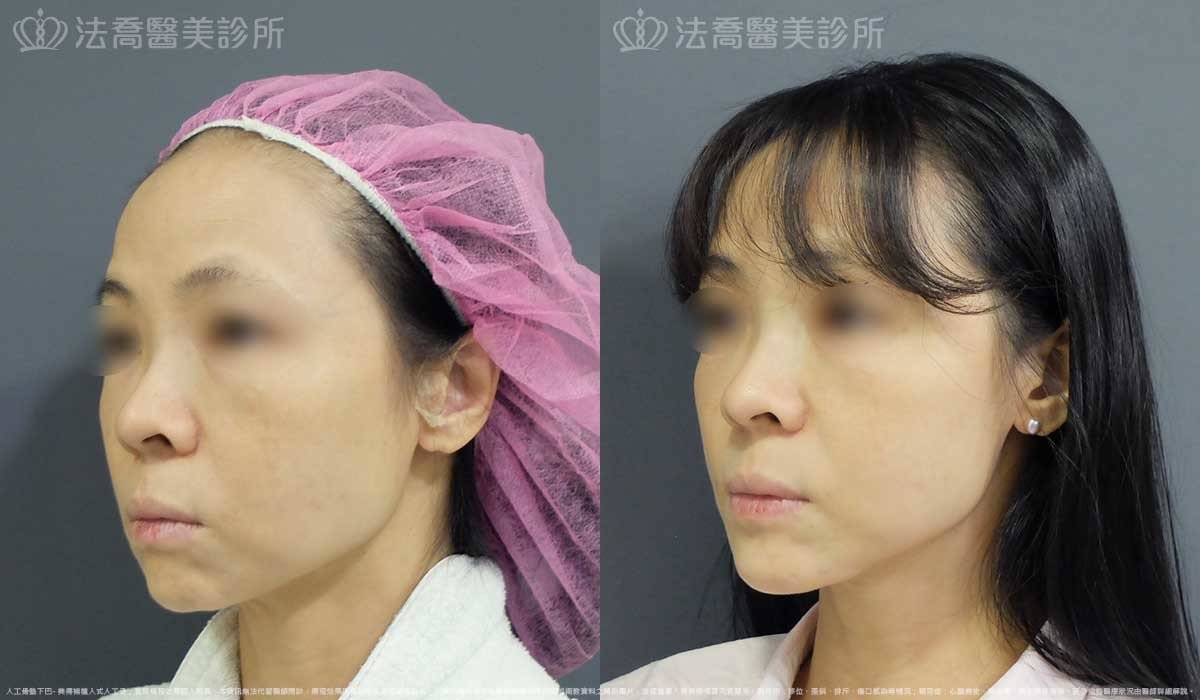 法喬醫美診所,邱浚彥,墊下巴