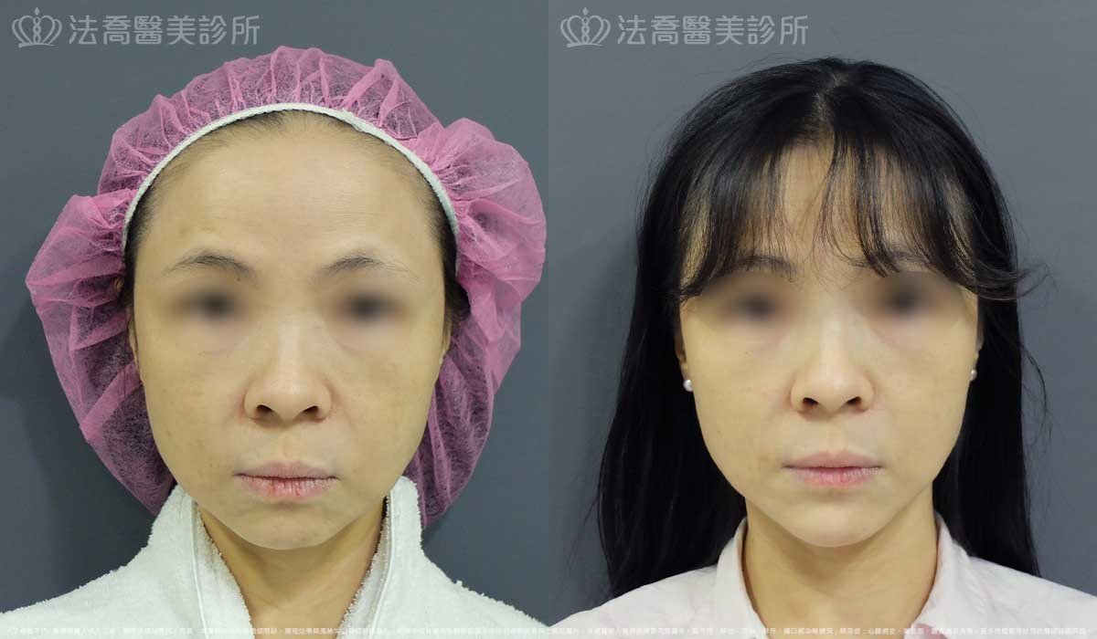 法喬醫美診所,邱浚彥,墊下巴