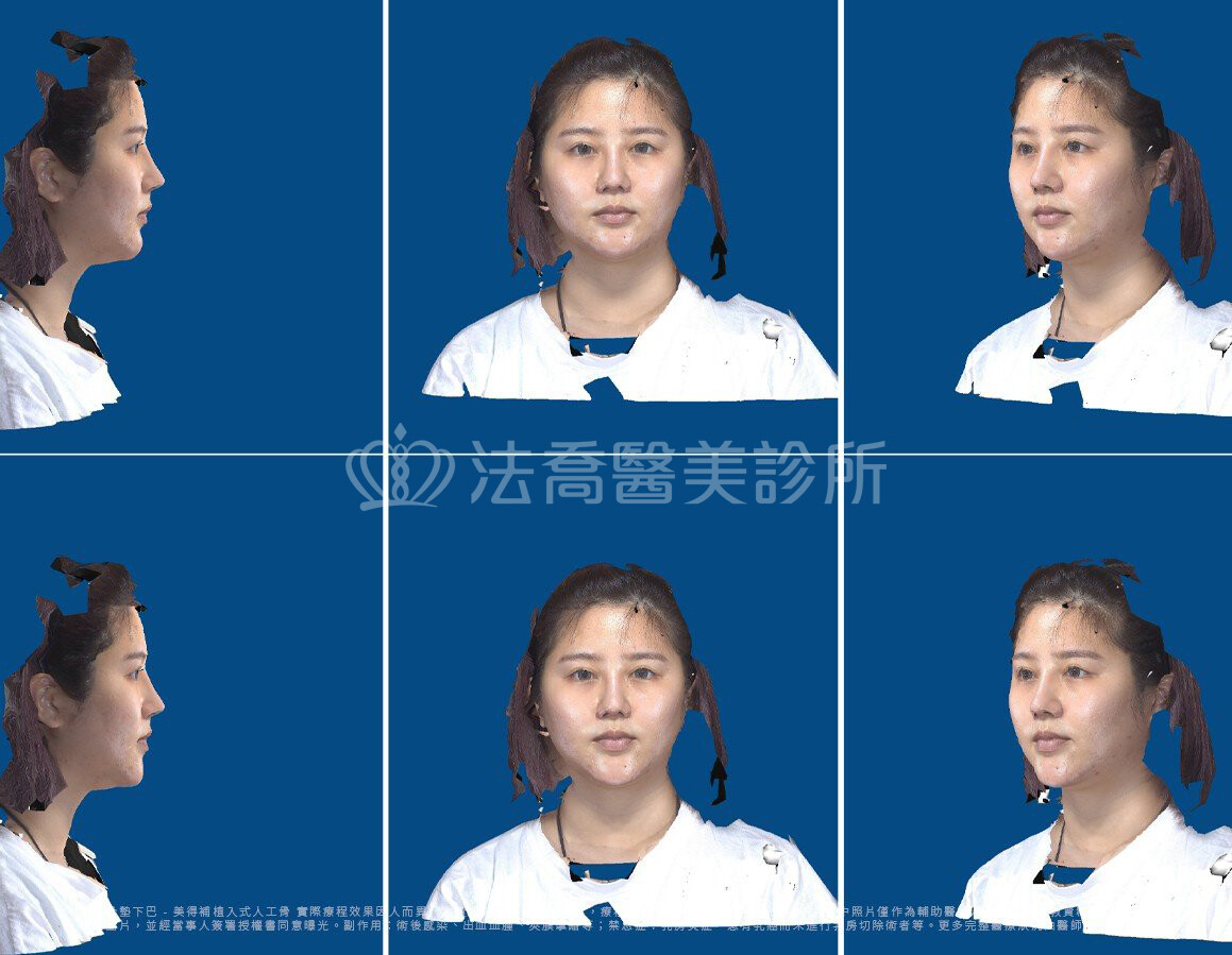 術前模擬