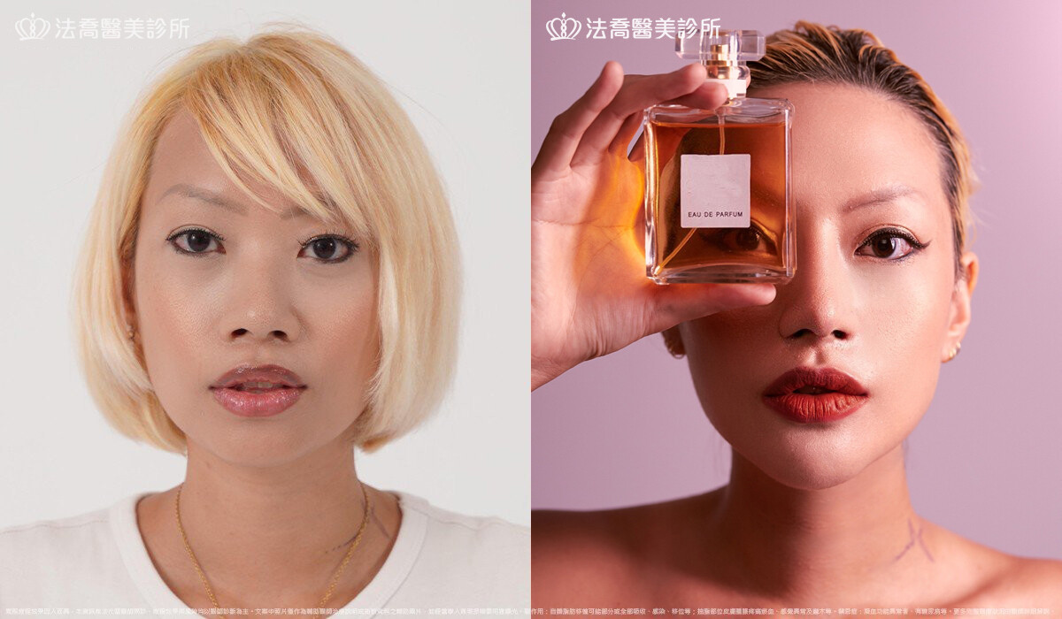 人工骨墊下巴(俗稱)