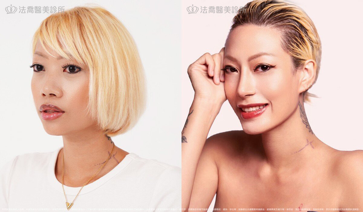 人工骨墊下巴(俗稱)