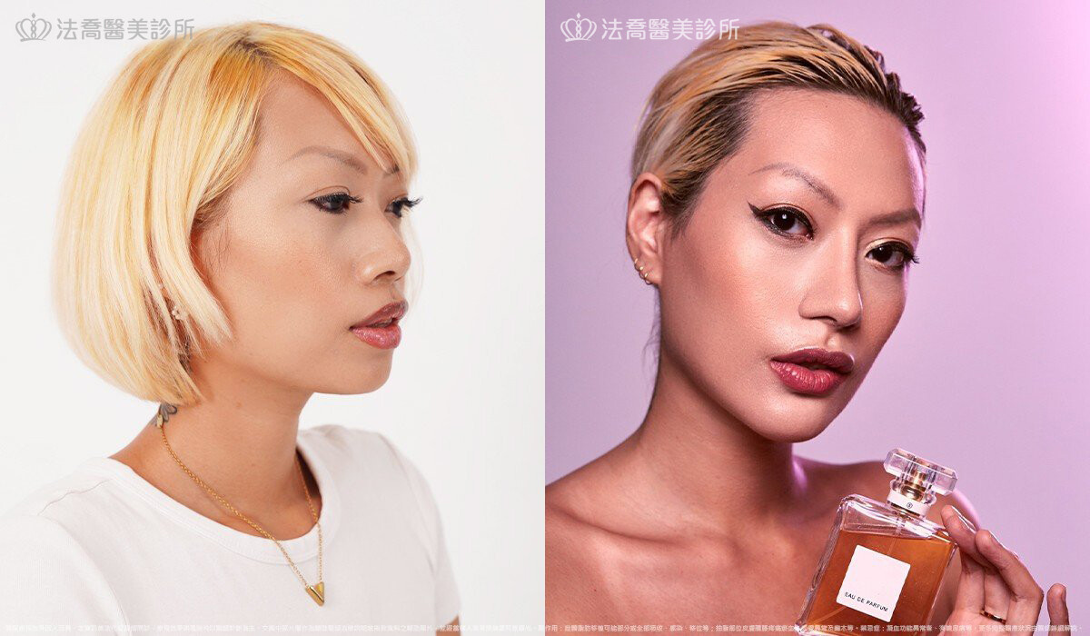 人工骨墊下巴(俗稱)