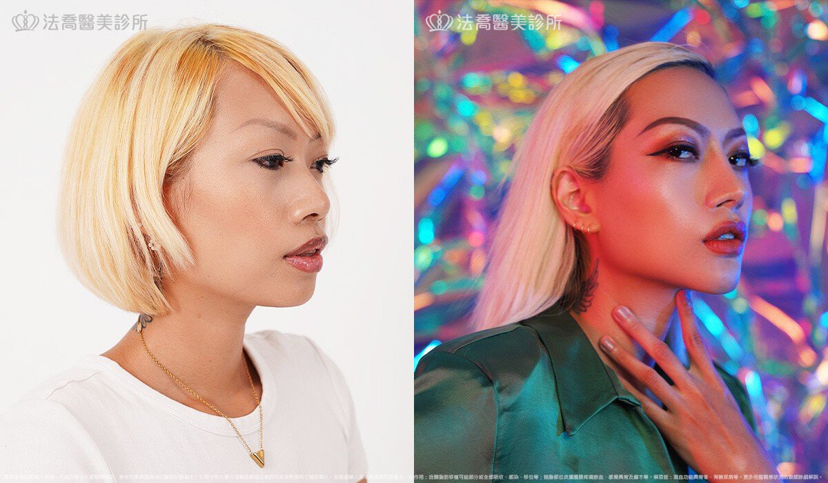 人工骨墊下巴(俗稱)