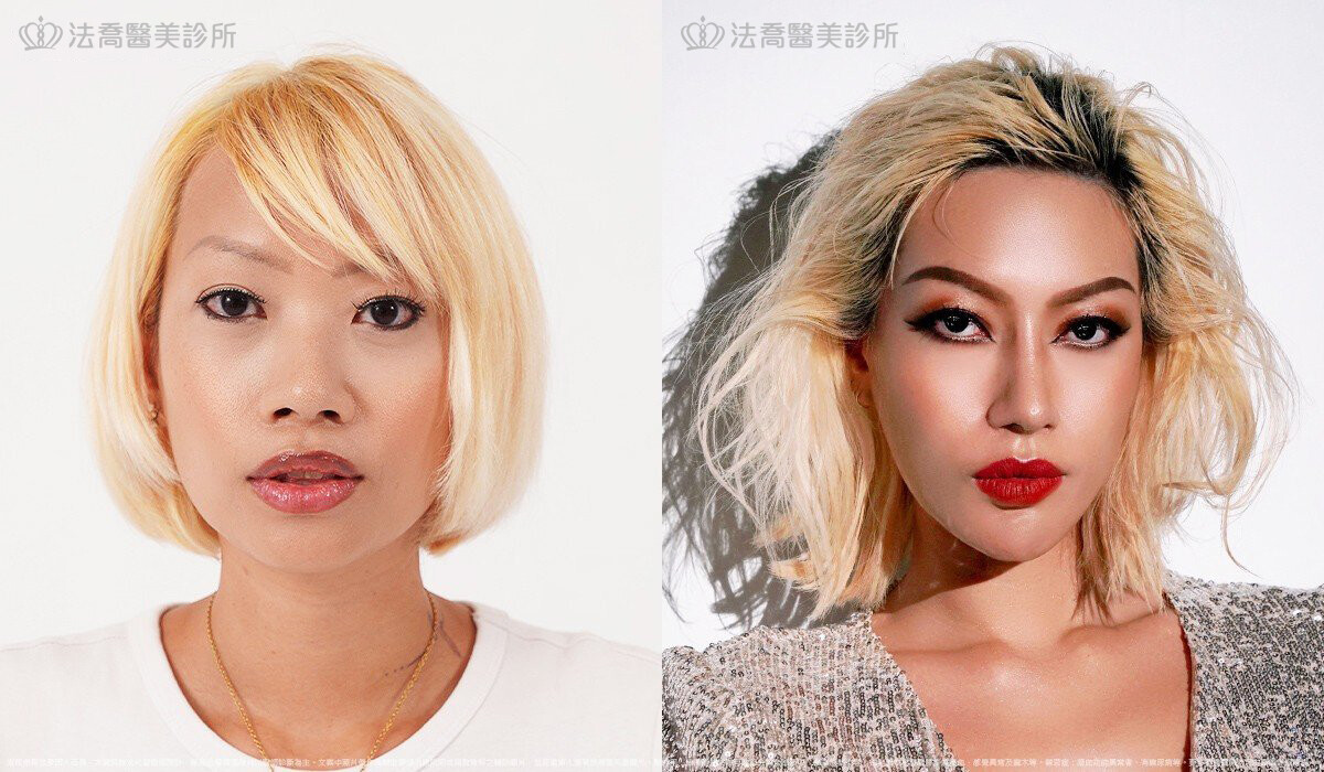 人工骨墊下巴(俗稱)