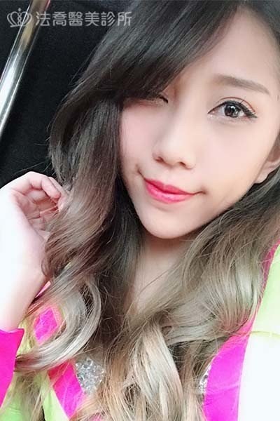 自體肋骨隆鼻