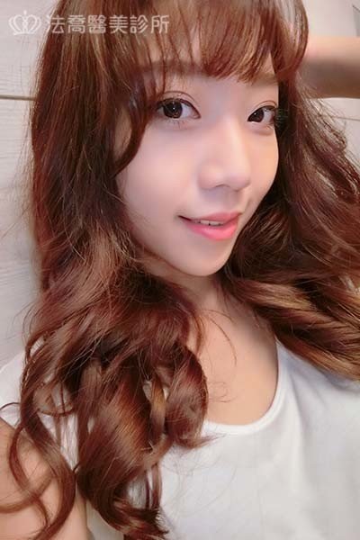 自體肋骨隆鼻