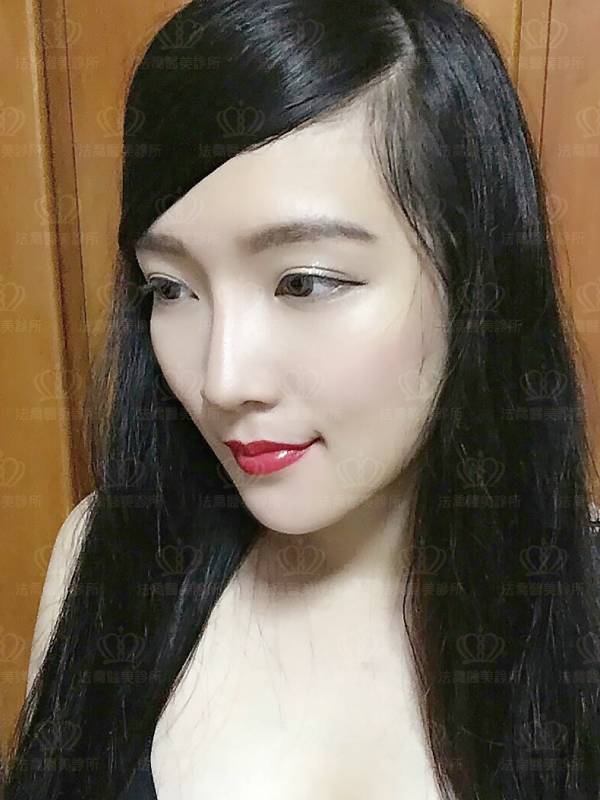 /files/images/案例分享/墊下巴/Eva/(術後1個月)Eva_人工骨墊下巴-2.jpg?1563345660