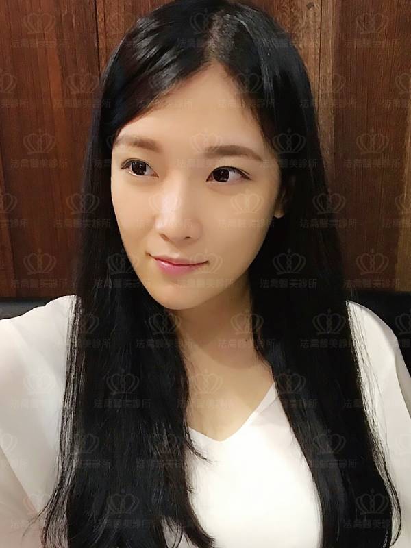 /files/images/案例分享/墊下巴/Eva/(術後1.5個月)Eva_人工骨墊下巴.jpg?1563348012