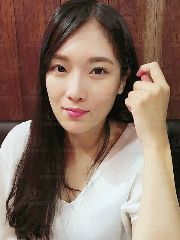 /files/images/案例分享/墊下巴/Eva/(術後1.5個月)Eva_人工骨墊下巴-2.jpg?1563348011