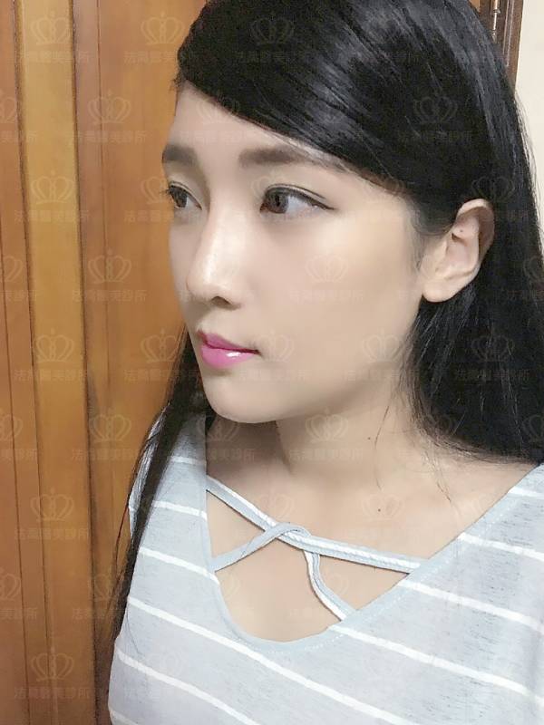 /files/images/案例分享/墊下巴/Eva/(術後15天)Eva_人工骨墊下巴-2.jpg?1563274987