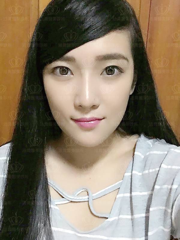 /files/images/案例分享/墊下巴/Eva/(術後15天)Eva_人工骨墊下巴.jpg?1563274987