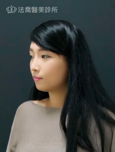 /files/images/案例分享/墊下巴/Eva/(術後1個月)Eva_人工骨墊下巴.jpg?1563345660