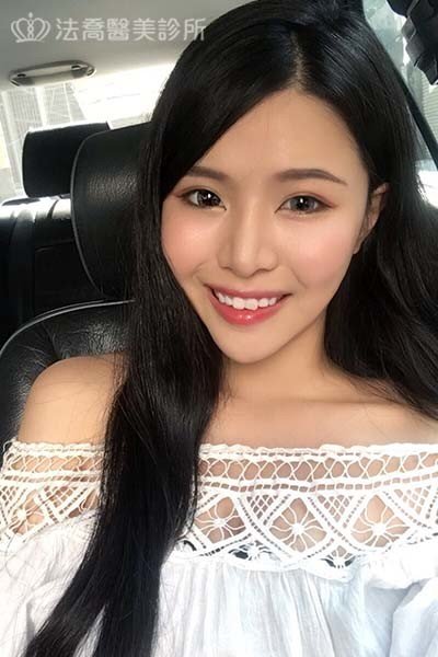 自體肋骨隆鼻