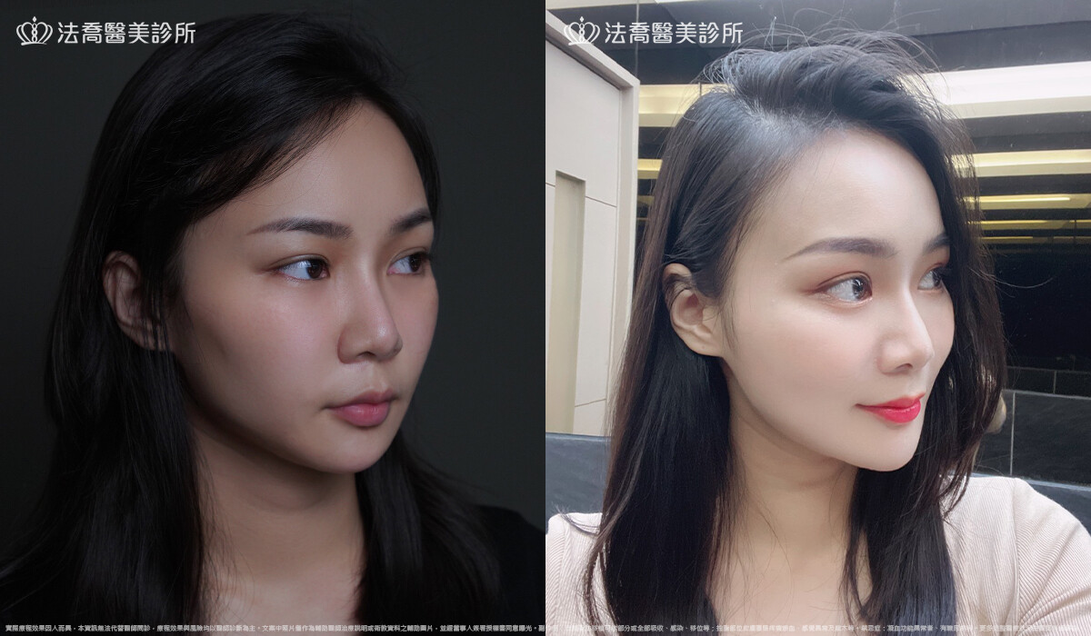 人工骨墊下巴(俗稱)