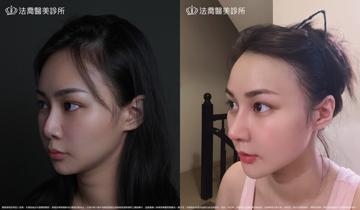 人工骨墊下巴(俗稱)