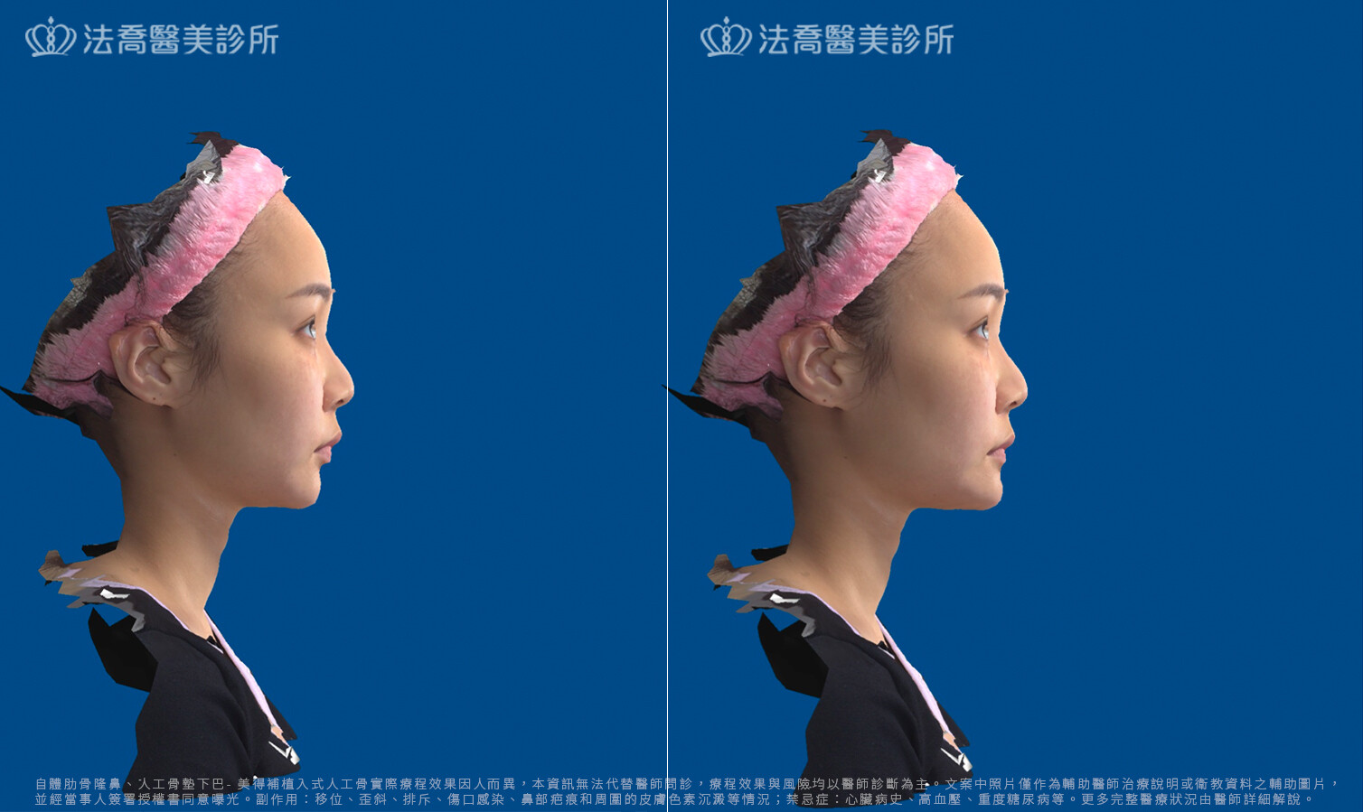 術前模擬