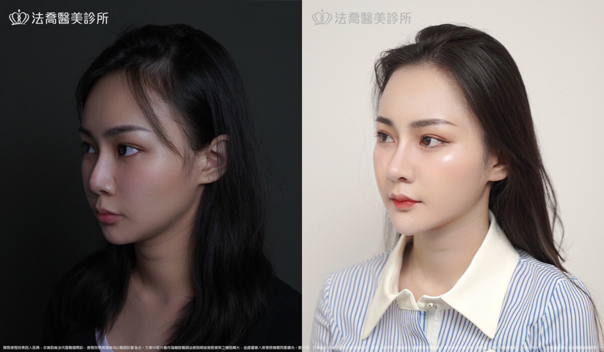 人工骨墊下巴(俗稱)