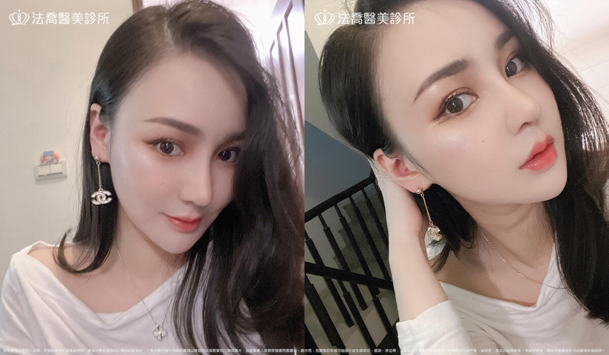 人工骨墊下巴(俗稱)