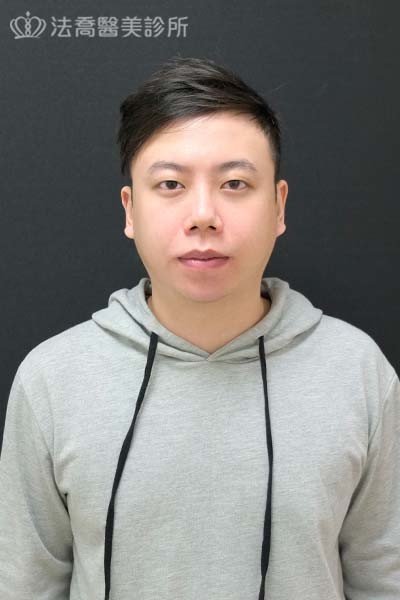 自體肋骨隆鼻