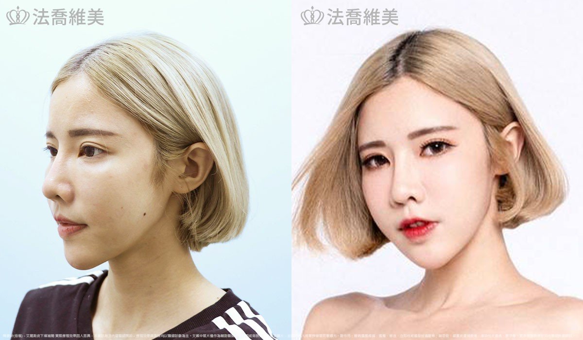 艾麗斯皮下填補劑 (俗稱 精靈針 ) 術前與術後一個月