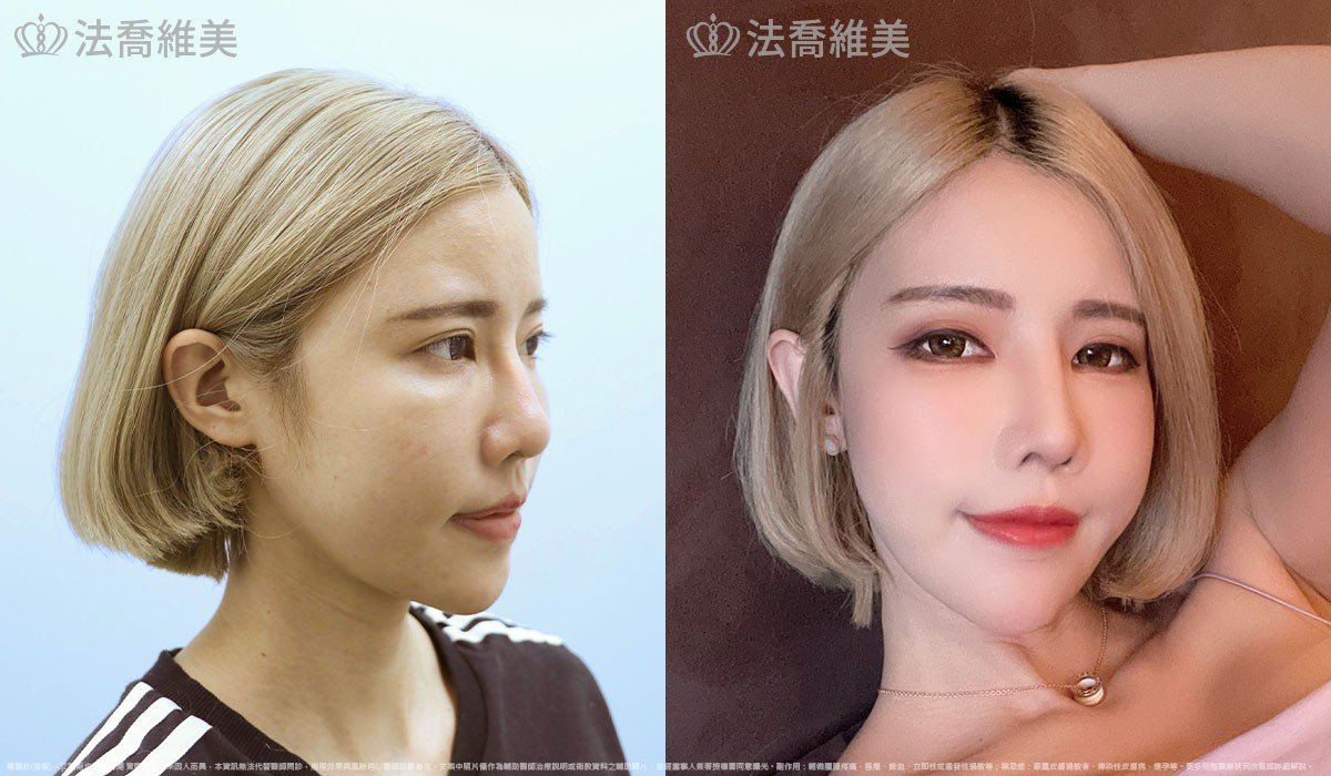 艾麗斯皮下填補劑 (俗稱 精靈針 ) 術前與術後一個月