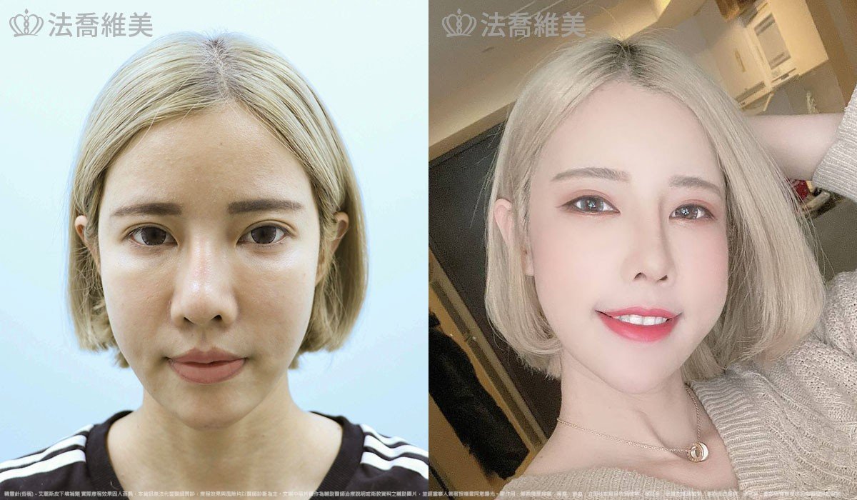 艾麗斯皮下填補劑 (俗稱 精靈針 ) 術前與術後一個月