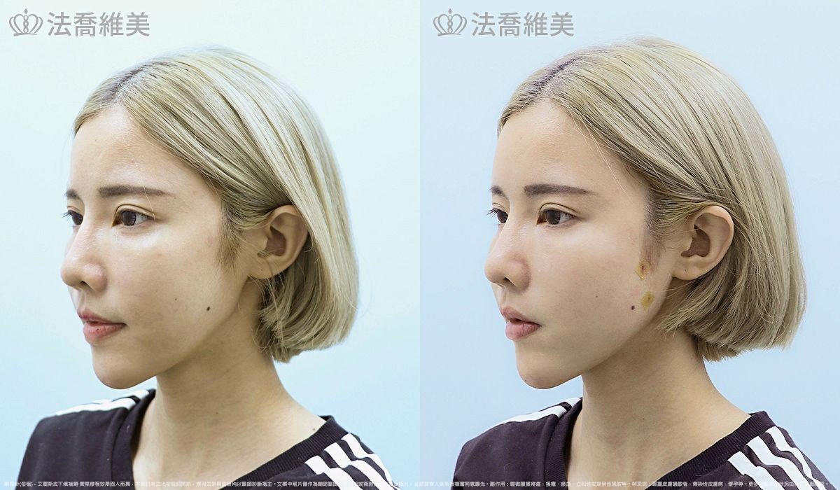 艾麗斯皮下填補劑 (俗稱 精靈針 ) 術前與術後當下