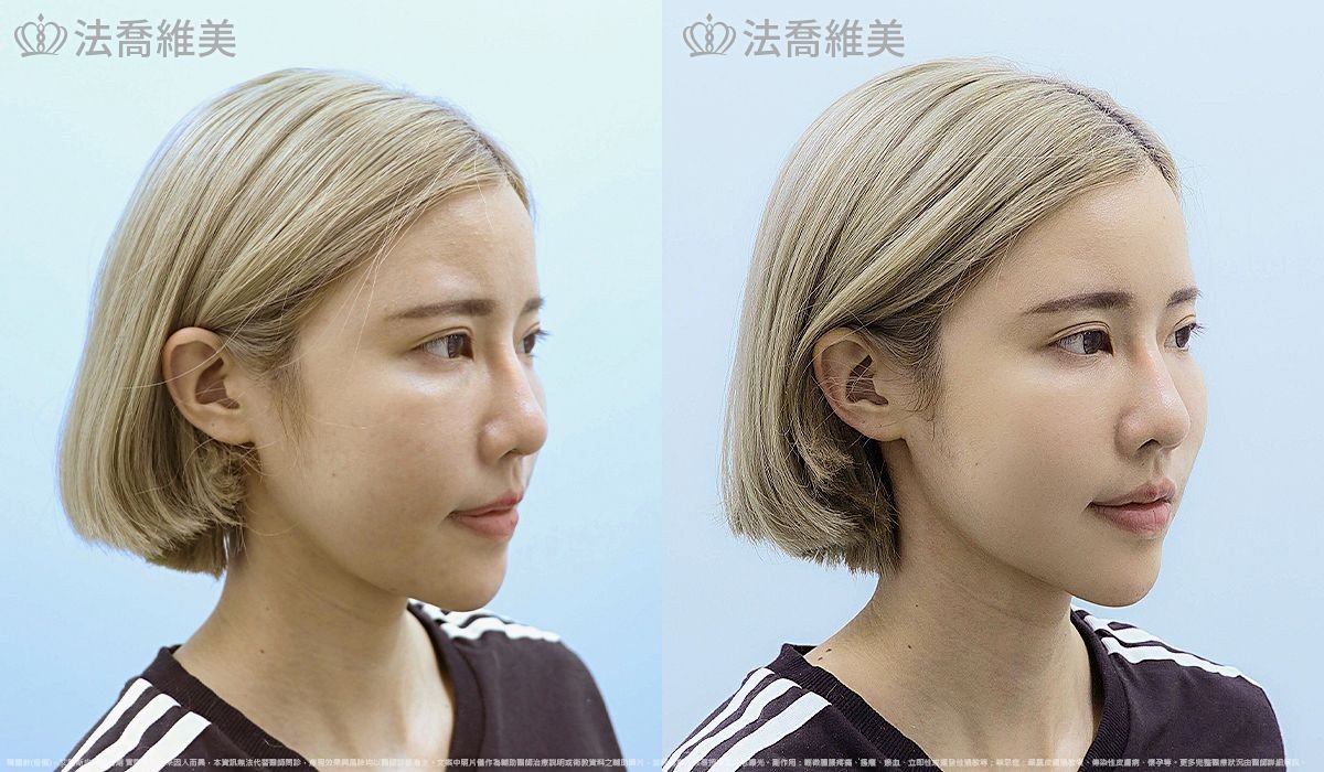 艾麗斯皮下填補劑 (俗稱 精靈針 ) 術前與術後當下