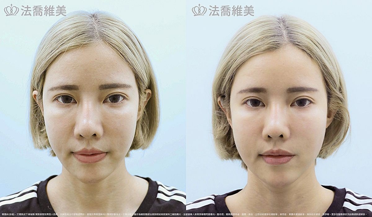 艾麗斯皮下填補劑 (俗稱 精靈針 ) 術前與術後當下