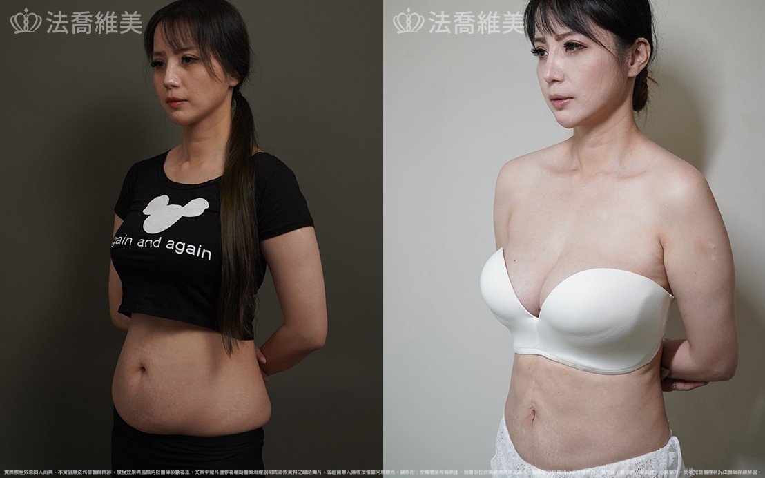腹部抽脂