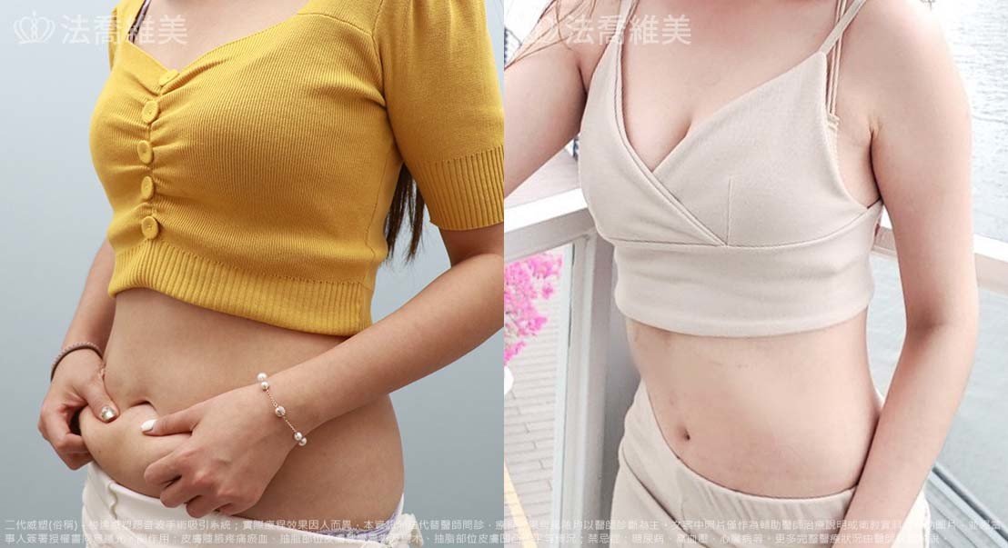 威塑豐胸補脂術後45天
