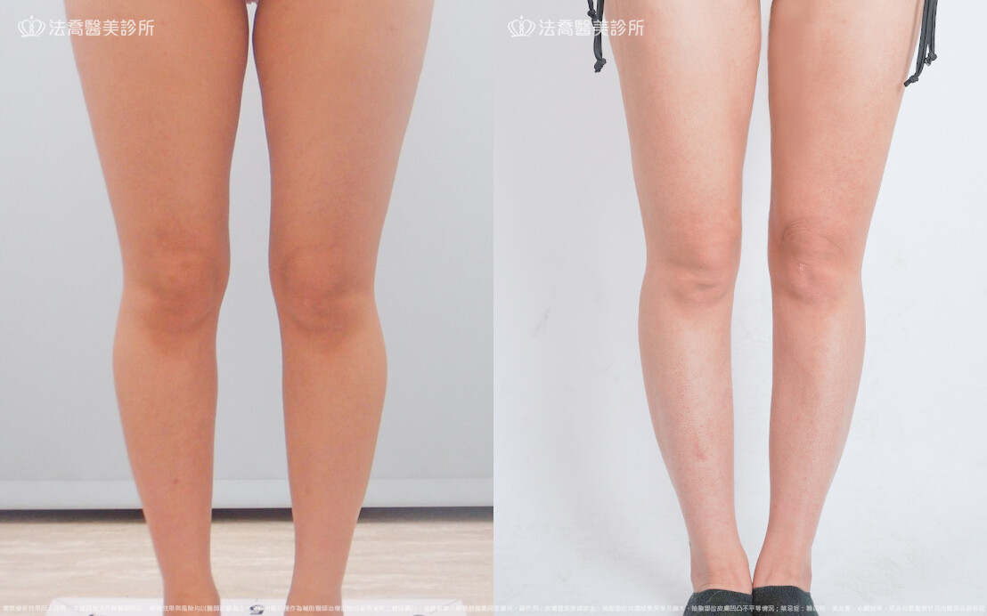法喬醫美診所,邱浚彥,威塑大腿環抽