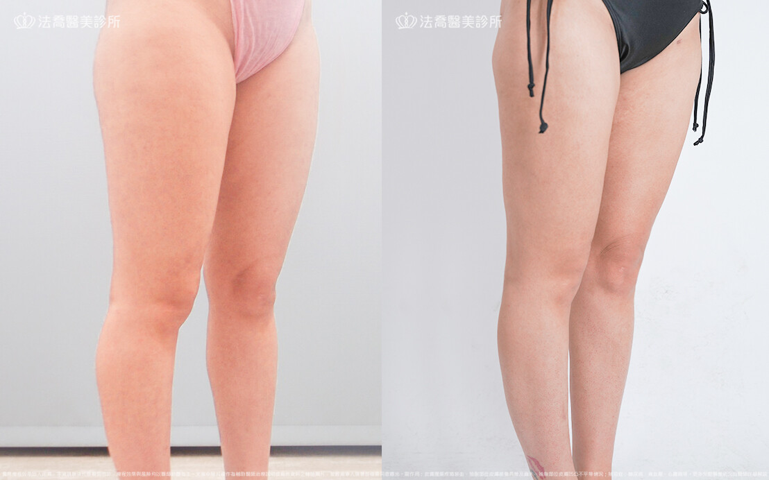 法喬醫美診所,邱浚彥,威塑大腿環抽