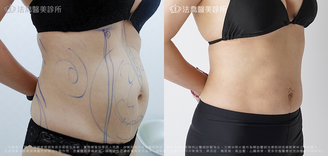 腹部環抽