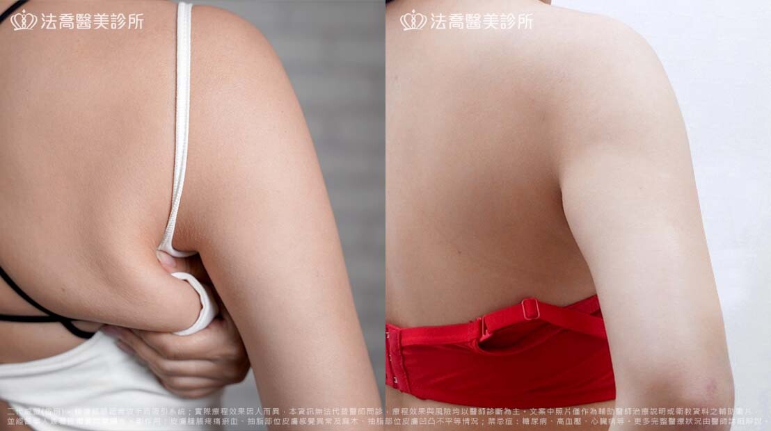 瘦肚子