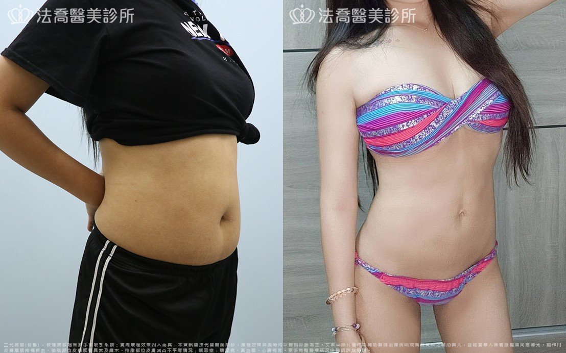 高雄法喬醫美,邱浚彥,威塑抽脂,自體脂肪豐臉