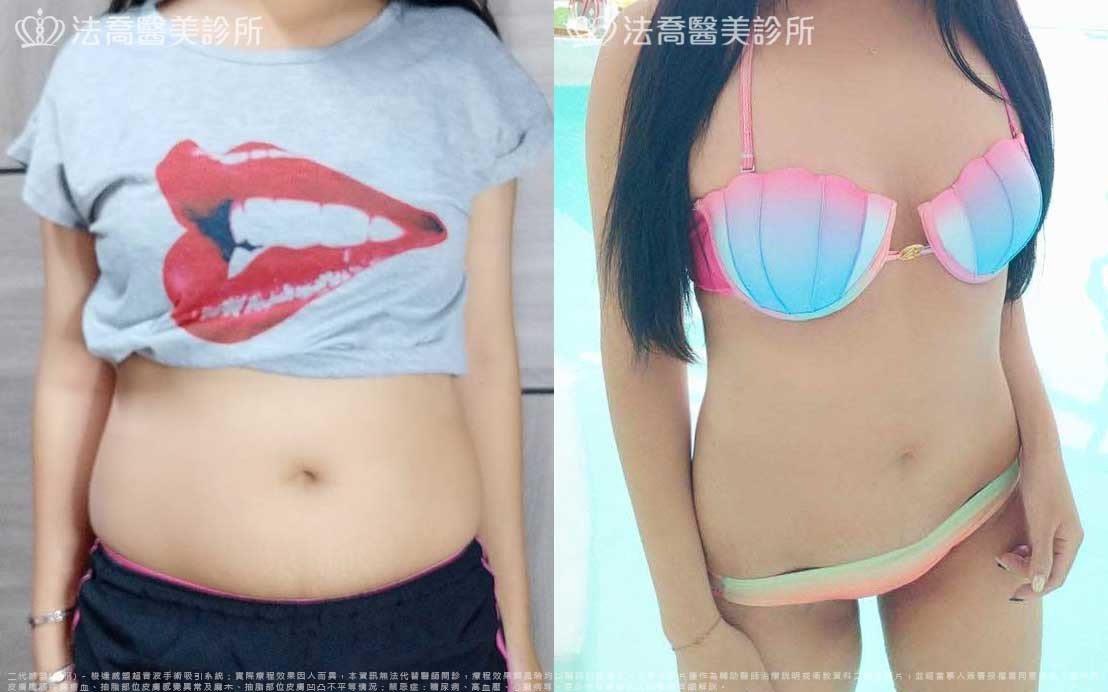高雄法喬醫美,邱浚彥,威塑抽脂,自體脂肪豐臉