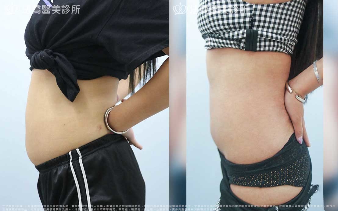 高雄法喬醫美,邱浚彥,威塑抽脂,自體脂肪豐臉