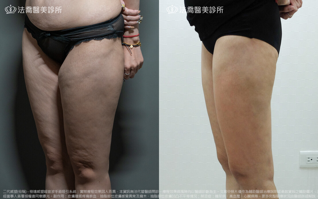 法喬醫美診所,邱浚彥,威塑抽脂