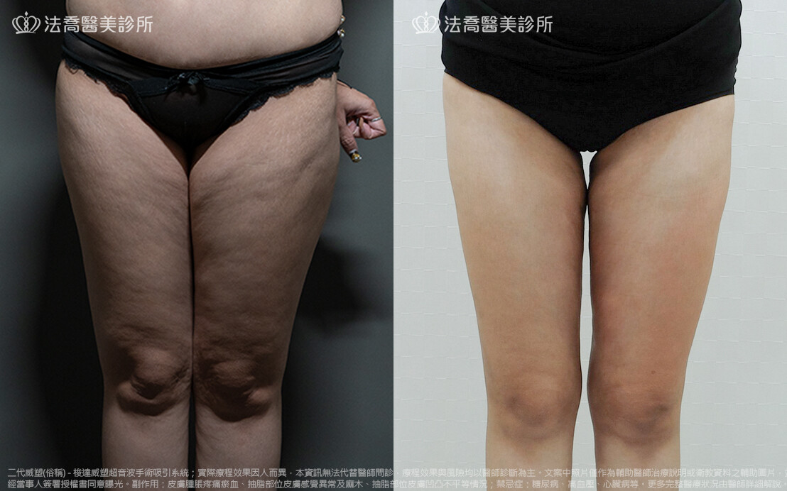 法喬醫美診所,邱浚彥,威塑抽脂