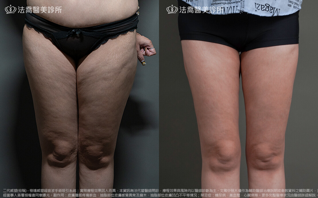 法喬醫美診所,邱浚彥,威塑抽脂